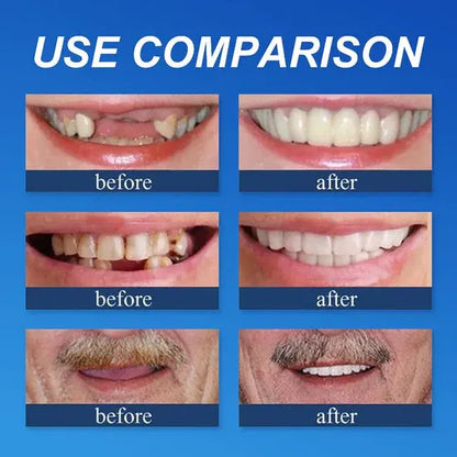 ⏰Ends Today: 70% OFF! 🌎KLENIMORE™ Custom-Fit  Dentures— Designed for Comfort and a Natural-Looking Smile