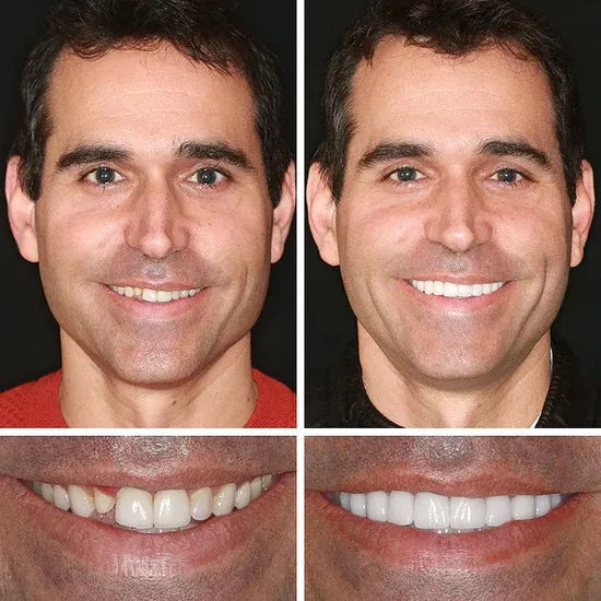 ⏰Ends Today: 70% OFF! 🌎KLENIMORE™ Custom-Fit  Dentures— Designed for Comfort and a Natural-Looking Smile