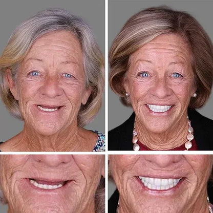 ⏰Ends Today: 70% OFF! 🌎KLENIMORE™ Custom-Fit  Dentures— Designed for Comfort and a Natural-Looking Smile
