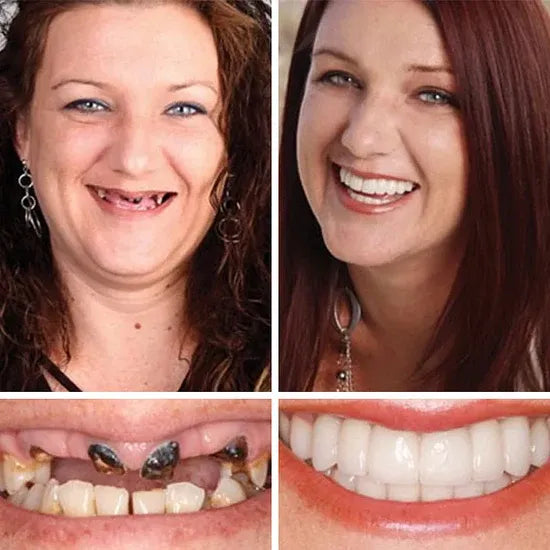 ⏰Ends Today: 70% OFF! 🌎KLENIMORE™ Custom-Fit  Dentures— Designed for Comfort and a Natural-Looking Smile