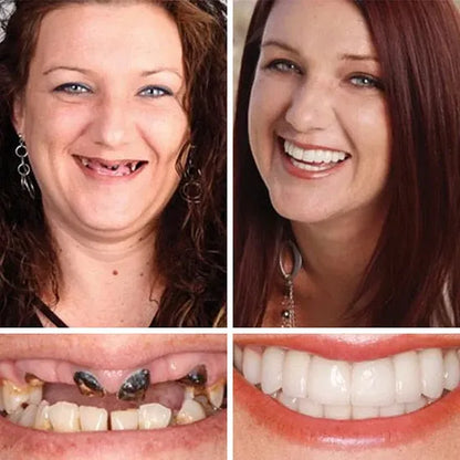 ⏰Ends Today: 70% OFF! 🌎KLENIMORE™ Custom-Fit  Dentures— Designed for Comfort and a Natural-Looking Smile