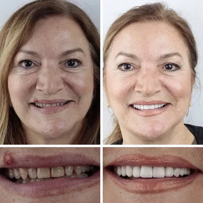 ⏰Ends Today: 70% OFF! 🌎KLENIMORE™ Custom-Fit  Dentures— Designed for Comfort and a Natural-Looking Smile